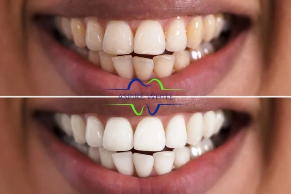 Aspire White customer before and after Preston results.