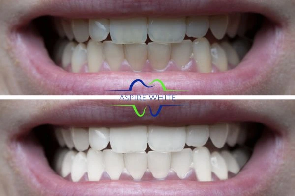 1 hour laser teeth whitening before and after results Preston
