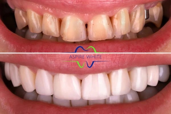 Yellow teeth results - 1 hour whitening before and after results Preston