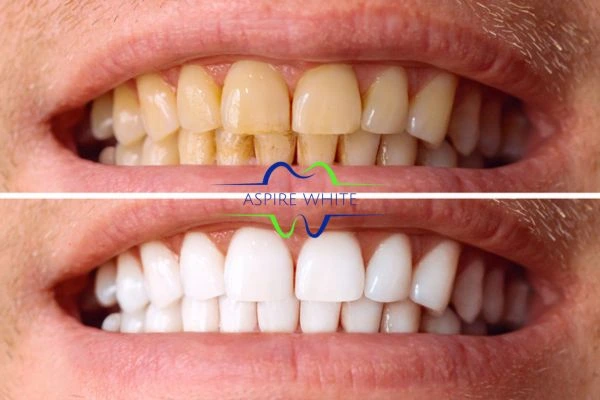 Get noticeable whiter smile in just one hour! Book your teeth whitening treatment Preston today!