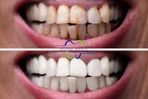 Before and after results of laser teeth whitening Preston Book in online today!