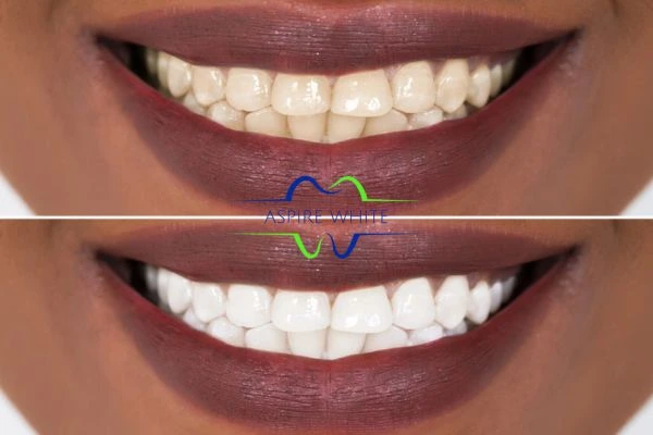 Side-by-side comparison showing before and after results of a cosmetic treatment Preston