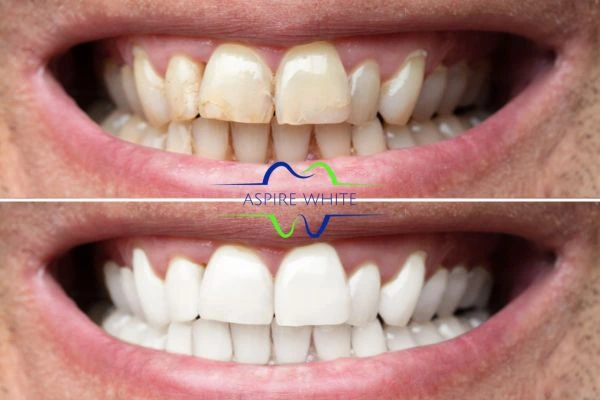 Before and after whitening results Preston
